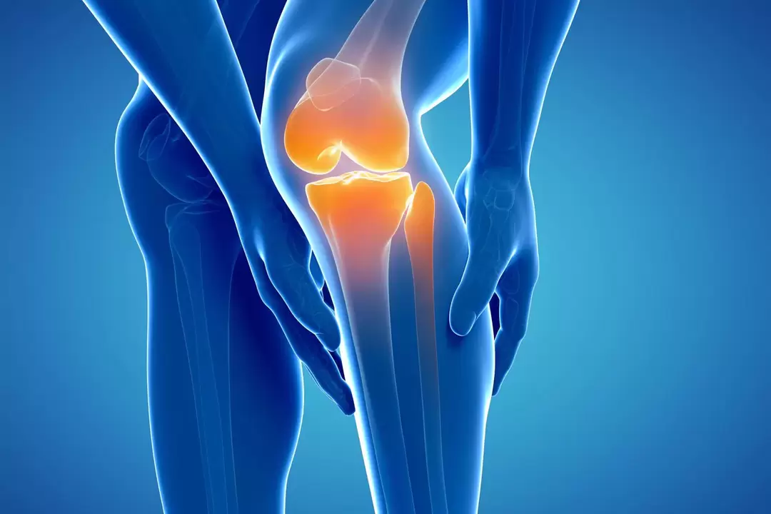 Artroza articulației genunchiului (gonartroză, artroză deformatoare)