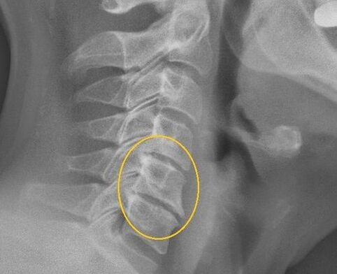 Osteochondroza coloanei vertebrale cervicale pe o raze X