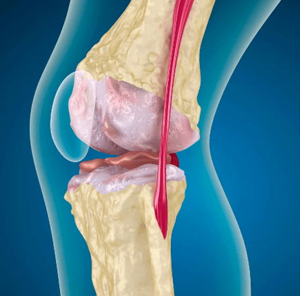 Arthrosis al articulației genunchiului