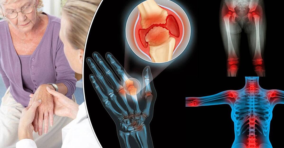 Ce este osteoartrita
